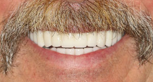 After CeraSmile, Dr. Rod Strickland's patient found a better way to replace his smile
