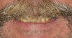 Before CeraSmile, Dr. Rod's patient needed a cosmetic dental makeover